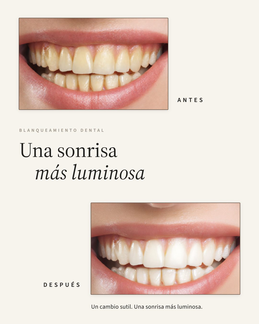 Publicación individual de antes y después: dos fotografías de la misma sonrisa, marcadas «Antes» y «Después», bajo el titular «Una sonrisa más luminosa» y la etiqueta «Blanqueamiento dental».